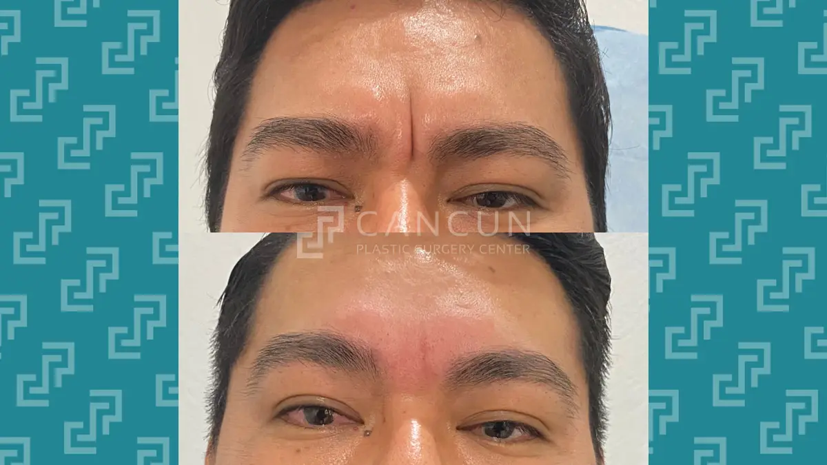 Before after Ritidectomia 1