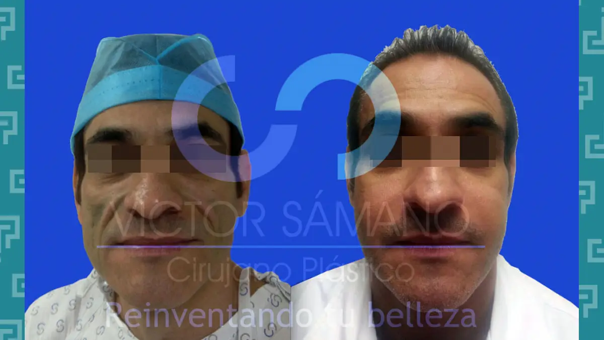 Before after Ritidectomia 2