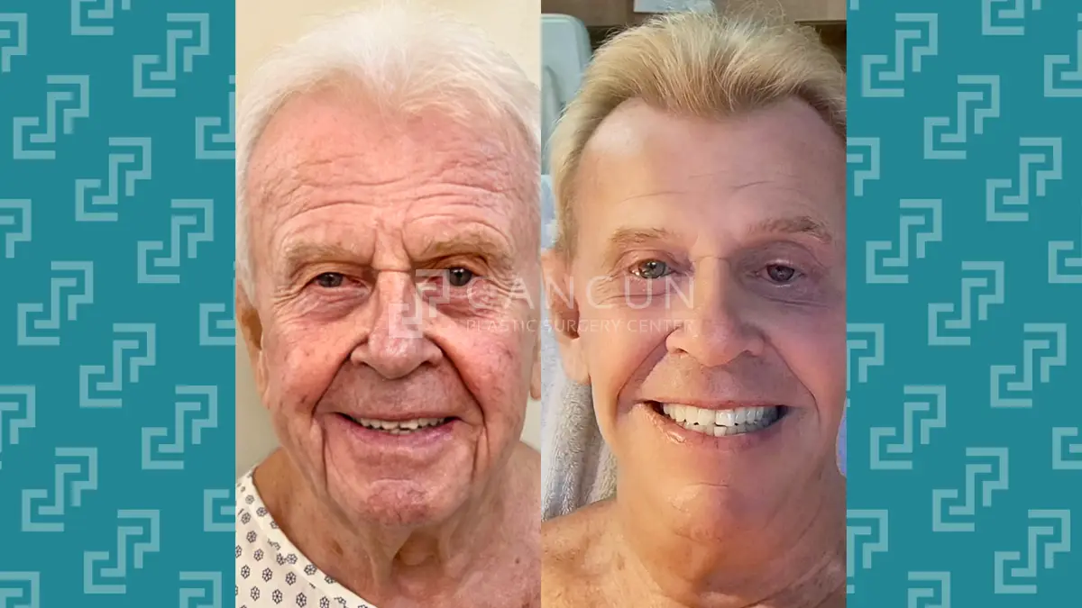 Before after Ritidectomia 3