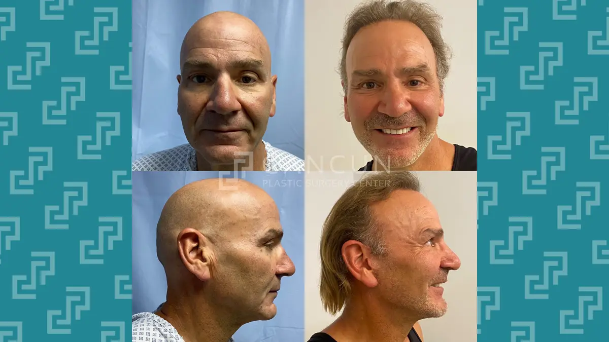 Before after Ritidectomia 4