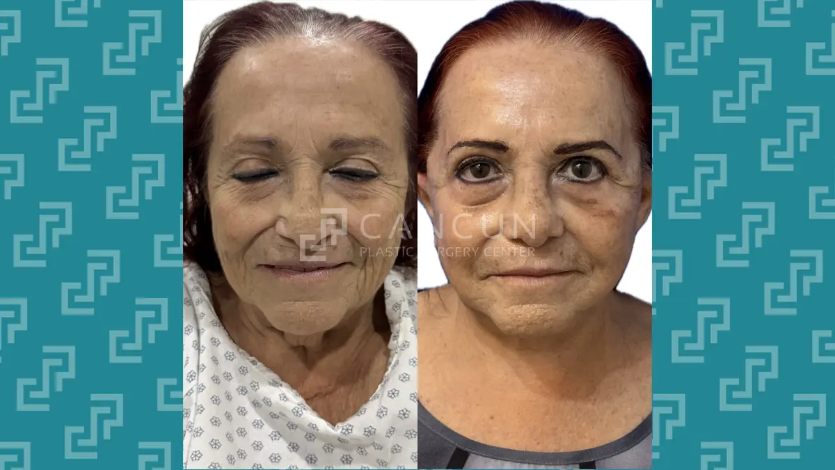 Before after Ritidectomia 5