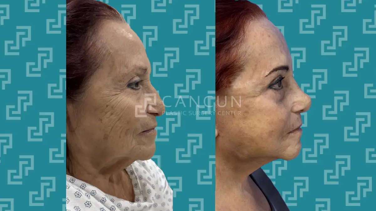 Before after Ritidectomia 6