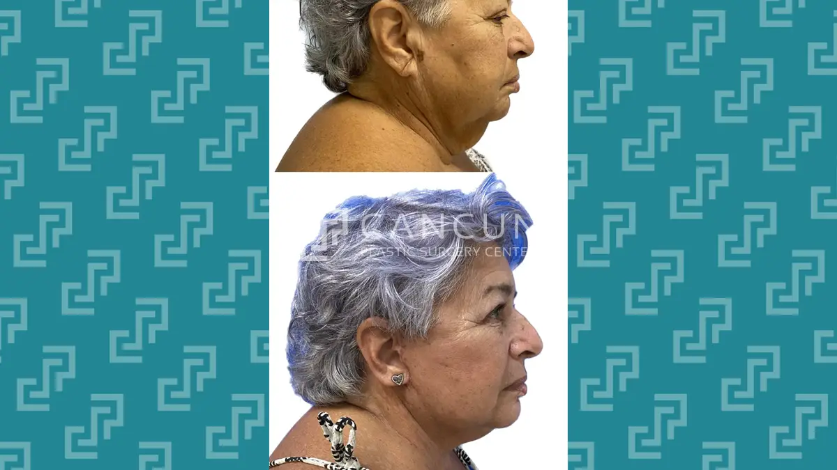 Before after Ritidectomia 7