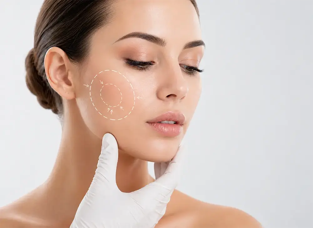 Bichectomy zone marking on cheek with guiding lines and pre-operative medical evaluation for facial aesthetic surgery in a specialized clinic