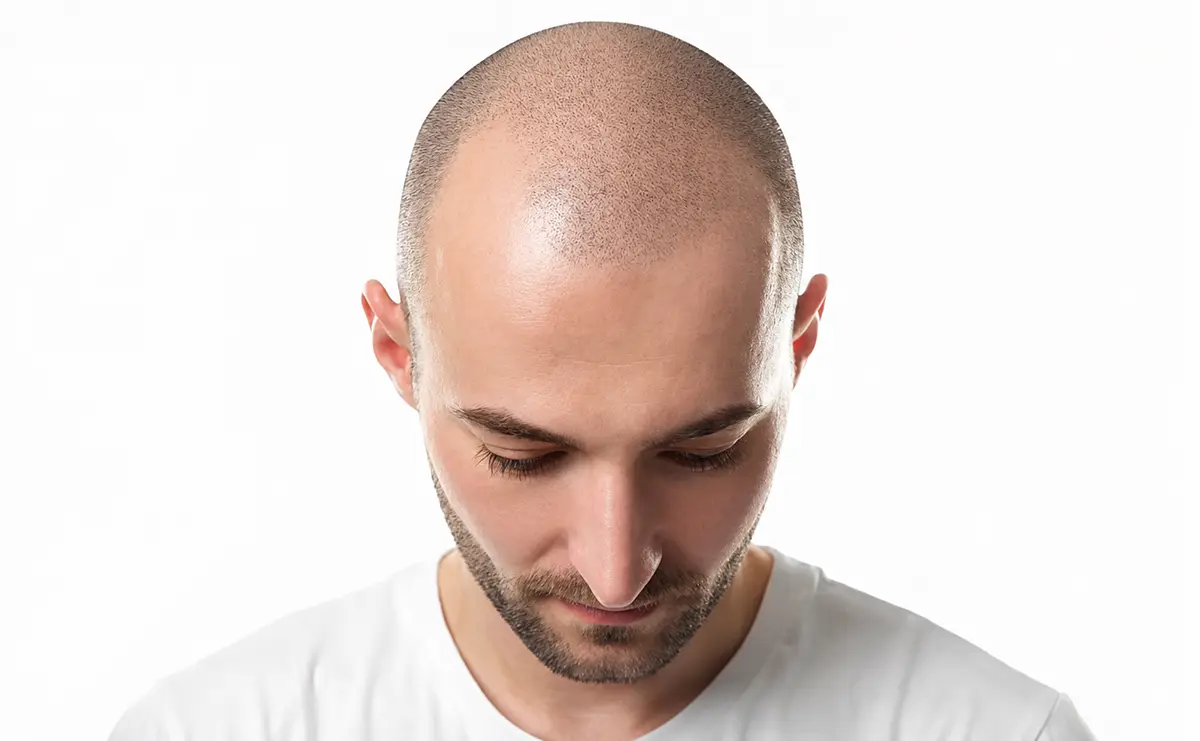 Representación visual de pérdida capilar masculina y diseño de línea frontal previo a un procedimiento de injerto capilar.